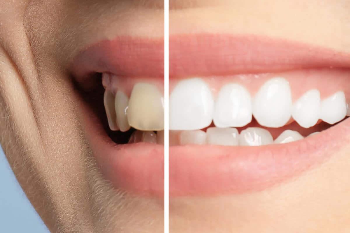A visualization of a before / after picture of a person who has slightly brown teeth before teeth whitening and the resulting white teeth after.