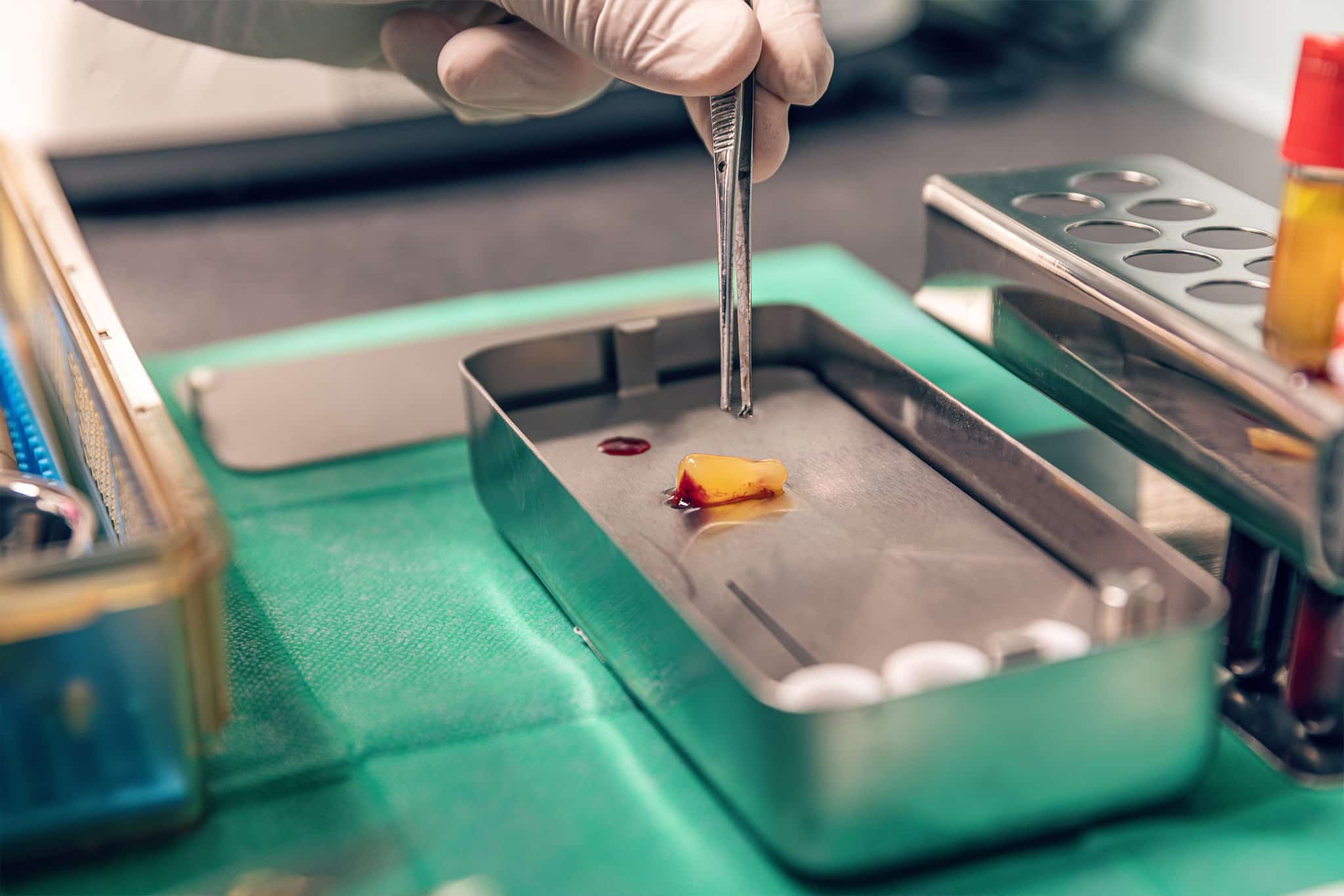 A picture of a prepared platelet rich fibrin piece at a dental office.