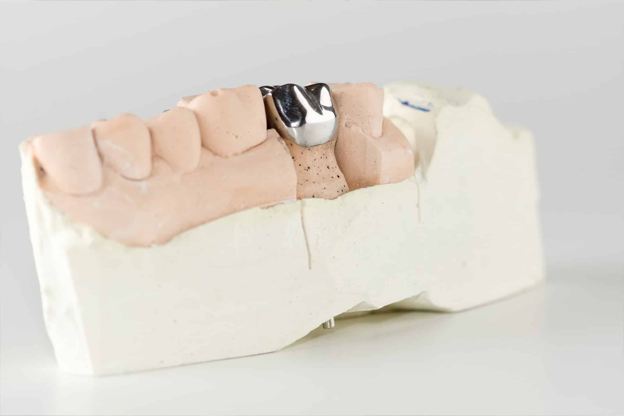 A photo of a metal dental crown, which is unavailable as a same day dental crown.
