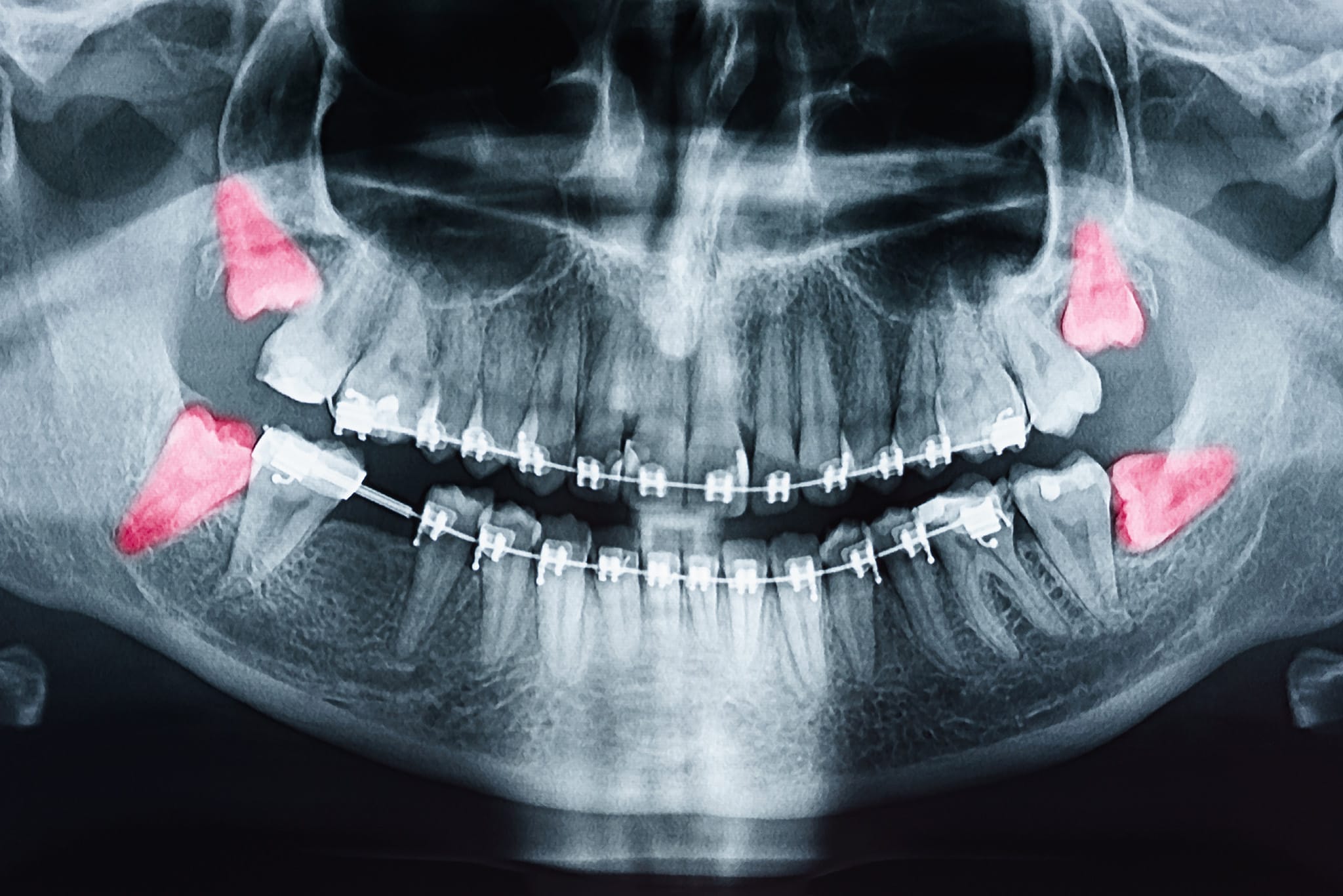 A photograph of an x-ray highlighting the location of wisdom teeth.