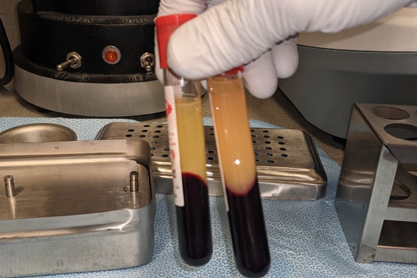 This photograph depicts two vials that have undergone the centrifugation process. There are three distinct layers that are present: the top layer of acellular plasma, a middle layer which is a fibrin clot that holds the growth factors and cytokines with the bottom layer of red blood cells. Typically the red blood cells are discarded.