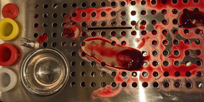 This photograph shows the platelet rich fibrin clot, which is placed in a sterile container. Depending on the procedure, the clot may be compressed or used as is. The PRF clot can be pressed down and used as a membrane in some surgeries such as bone grafting.