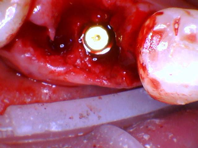 An intraoral photograph with the implant placed immediately following the extraction. The dental implant has a cover screw to protect the internals of the implant.