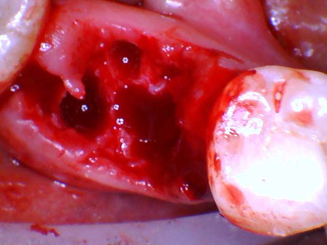 A photograph immediately following extraction of a hopeless tooth. The holes represent the roots of the removed tooth.