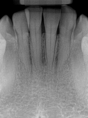 A periapical radiograph (PA) of the mandibular anterior teeth taken at a regular checkup prior to orthodontic treatment. Some recession is present but no other significant pathology is noted.