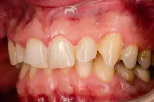 A picture of a mouth with gum disease.